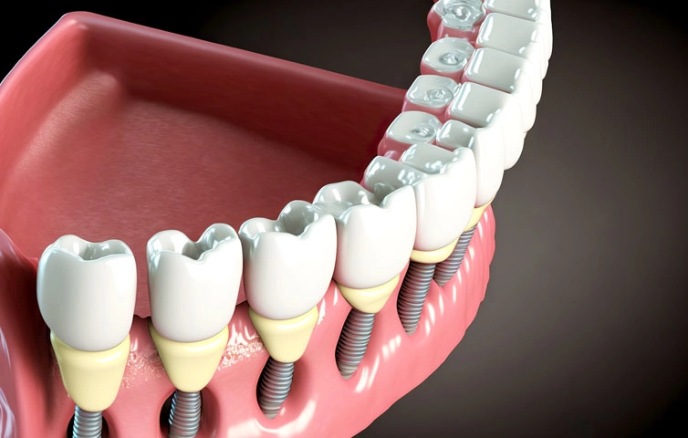 full mouth dental implants pros and cons full mouth dental implants pros and cons