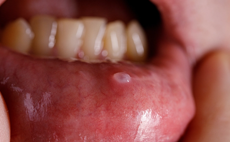 Pea Sized Lump in Mouth: Causes, When to Worry & What to Do Next