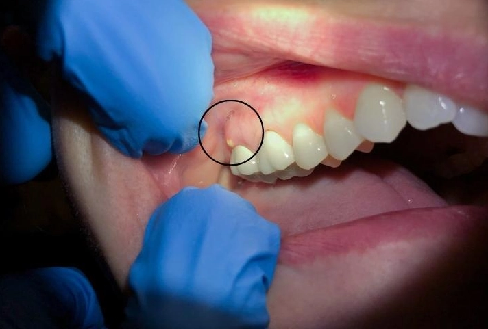 abscess root cause abscess root cause
