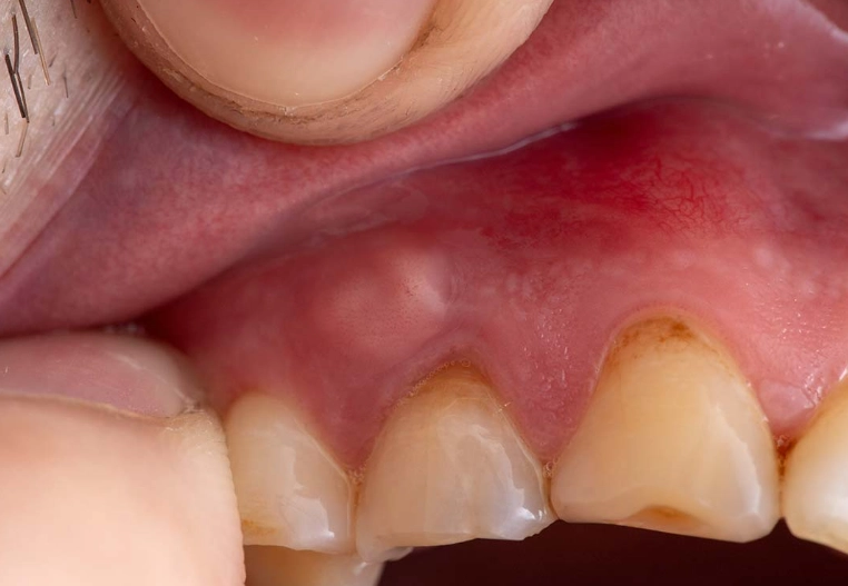 how long for tooth infection to abscess how long for tooth infection to abscess