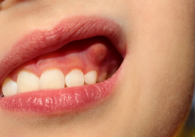 hard lump in cheek hard lump in cheek