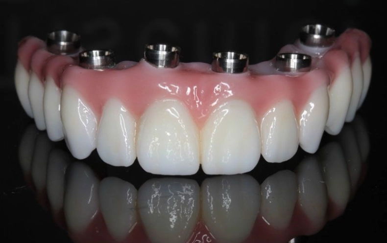 are dental implants worth the money are dental implants worth the money