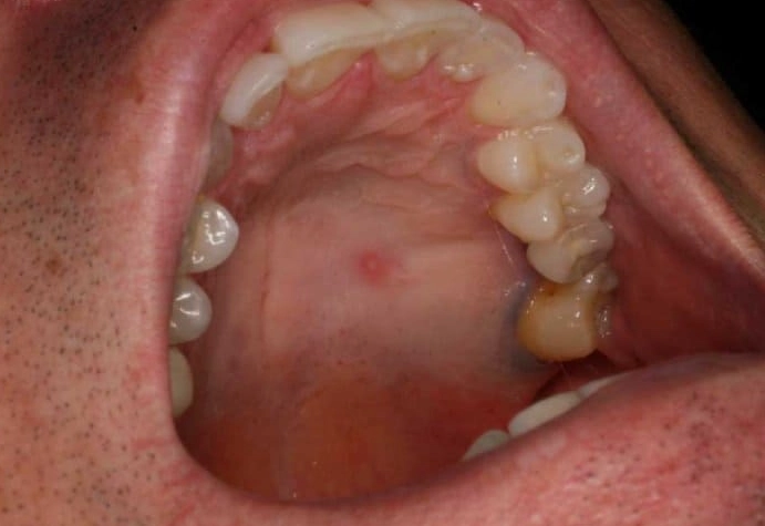 hard lump in cheek hard lump in cheek