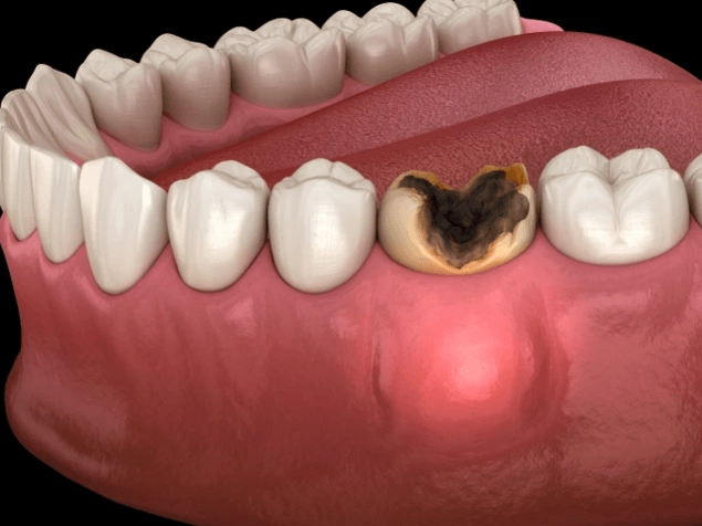 what causes an abscess what causes an abscess