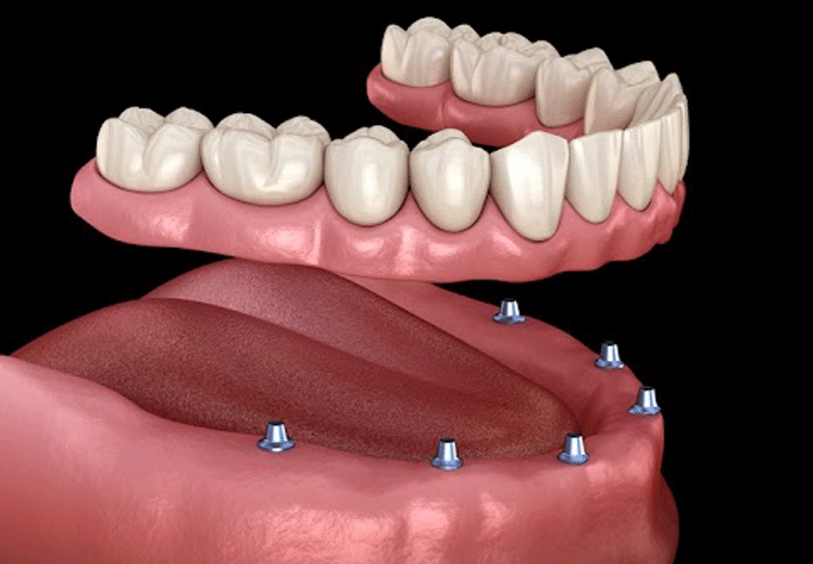 are dental implants worth the money are dental implants worth the money