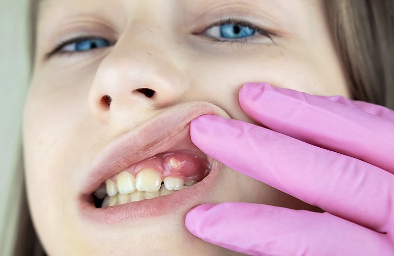 dental abscess treatment dental abscess treatment