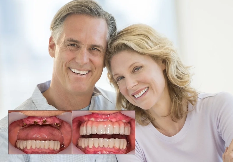 full mouth dental implants cost full mouth dental implants cost