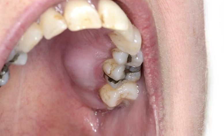 what causes an abscess what causes an abscess