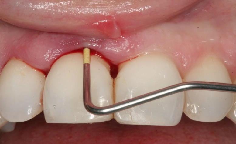 Dental Abscess Relief: How to Treat and Prevent Tooth Abscesses