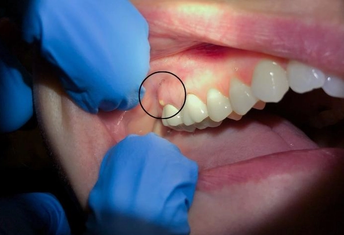 tooth abscess timeline tooth abscess timeline