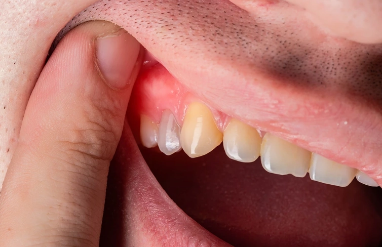 tooth abscess causes tooth abscess causes