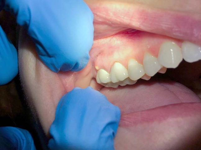 tooth infection symptoms tooth infection symptoms