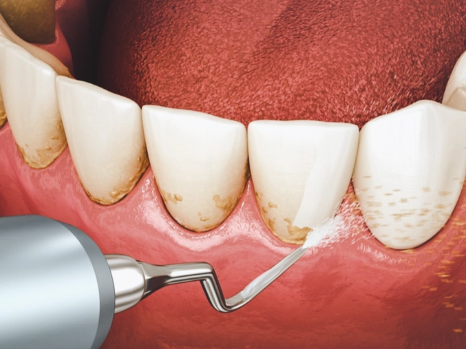 gum disease treatment cost
