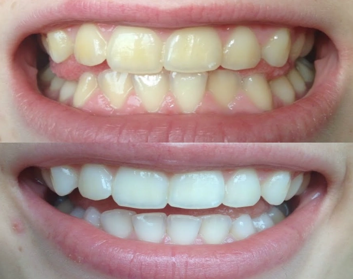 how long does teeth whitening last how long does teeth whitening last