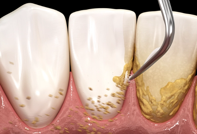 deep cleaning teeth cost deep cleaning teeth cost