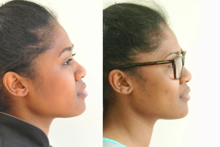 facial structure after wisdom teeth extraction facial structure after wisdom teeth extraction