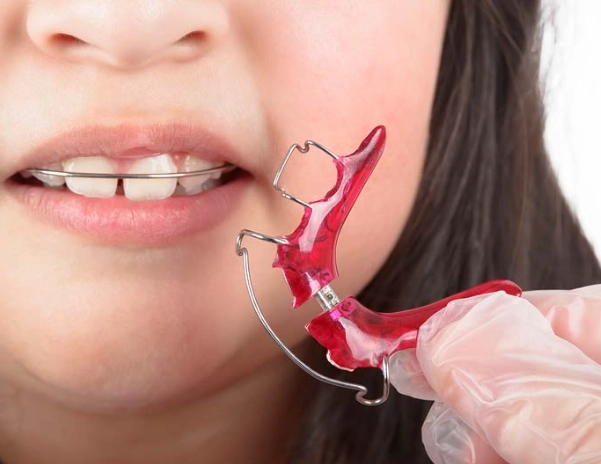 Your Ultimate Guide to Teeth Retainers: Types, Care & Costs