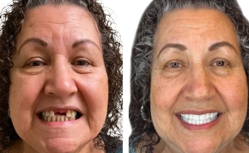 wisdom teeth removal effects on face wisdom teeth removal effects on face