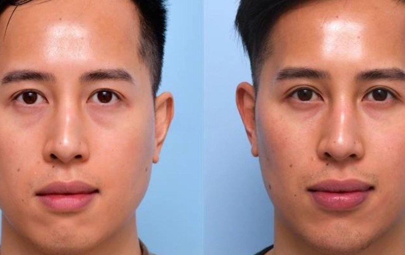 Does Removing Wisdom Teeth Change Your Face Shape? The Honest Truth