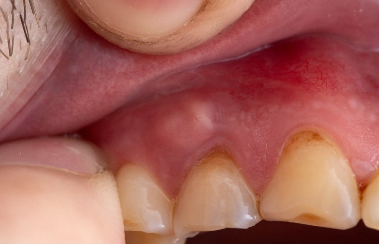 gum abscess treatment