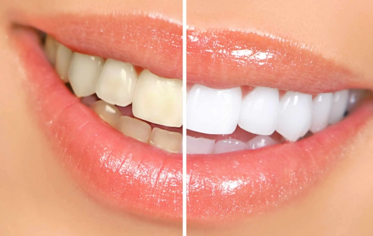 how to whiten teeth naturally