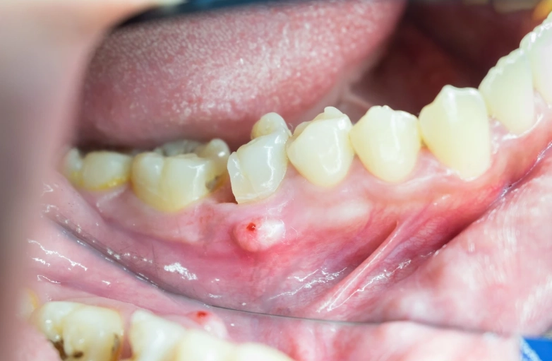 Tooth and Gum Abscess Guide: Symptoms, Treatment, and Prevention