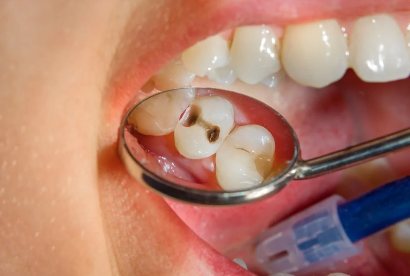 Cavity Dental Filling: Your Complete Guide to Types, Costs, and Recovery