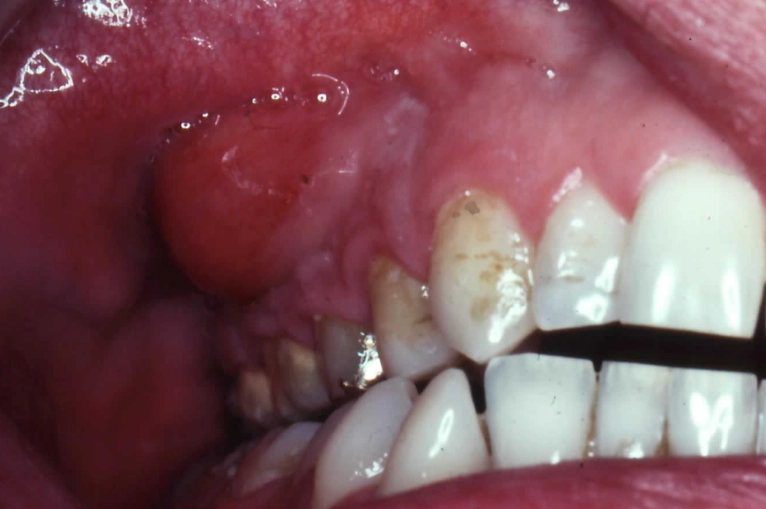 abscess tooth pain relief