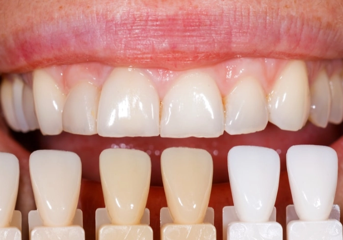 teeth whitening foods