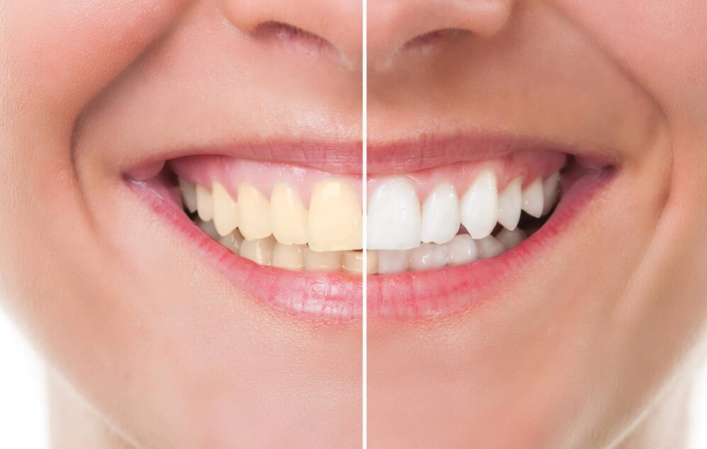 Ultimate Guide to What's Good for Teeth Whitening: Foods, Habits & Products