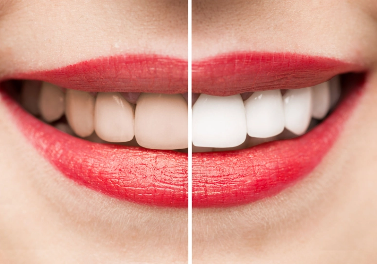 teeth whitening reviews
