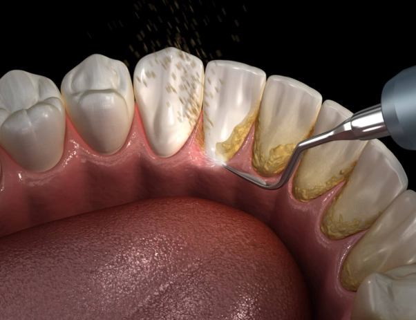 scaling and root planing