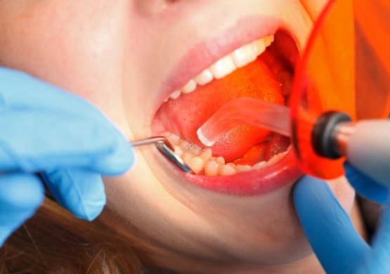 types of dental fillings