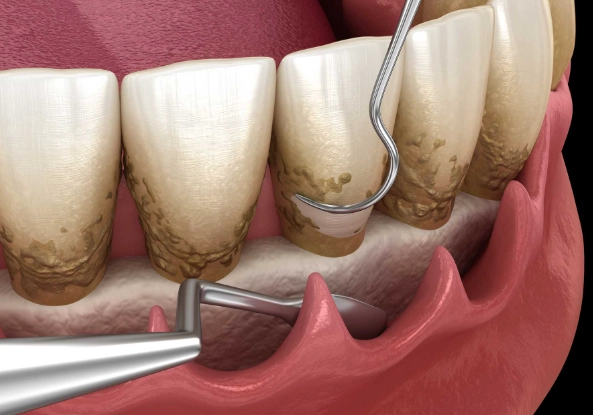 Dental Deep Cleaning Explained: Your Guide to Scaling and Root Planing