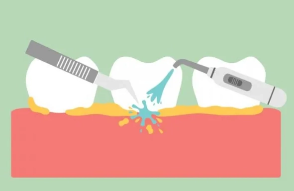 scaling and root planing