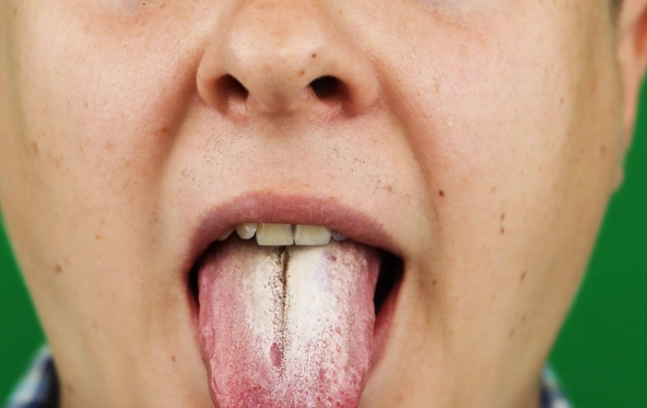 antifungal mouthwash