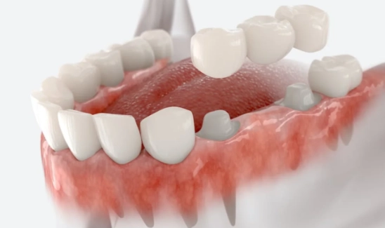 Glue Crown Tooth: Why It Fails and How to Fix It