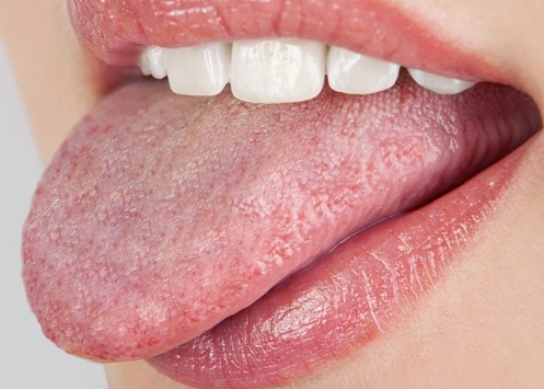 antifungal mouthwash