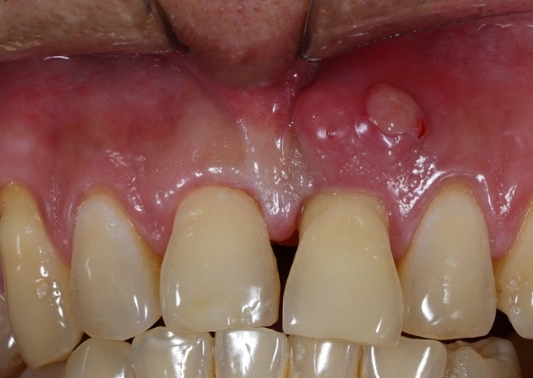 periapical abscess treatment