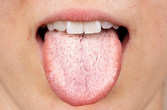 Oral Candidiasis Treatments: A Complete Guide to Curing Thrush