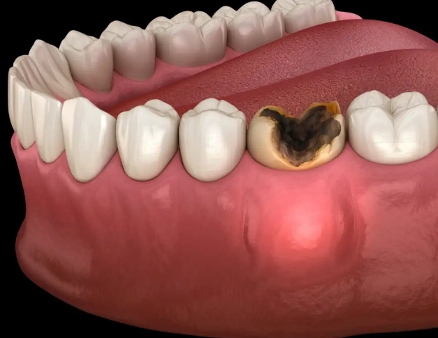 abscessed tooth treatment abscessed tooth treatment