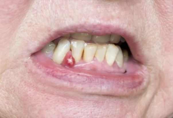 abscessed tooth