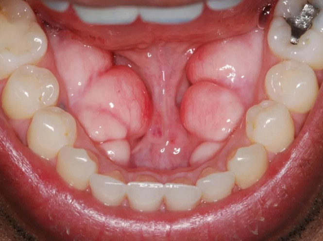 palatal tori
