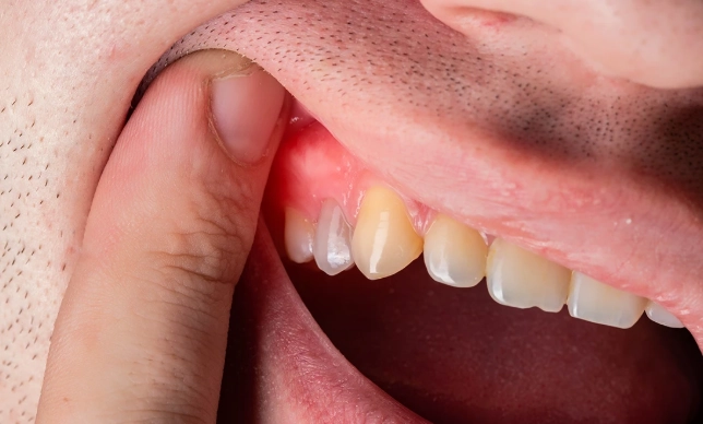 What Causes a Dental Abscess? A Dentist's Guide to Painful Tooth Infections