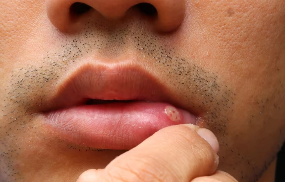 cure for oral thrush