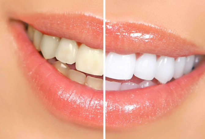 teeth whitening sensitivity