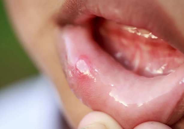 cure for oral thrush