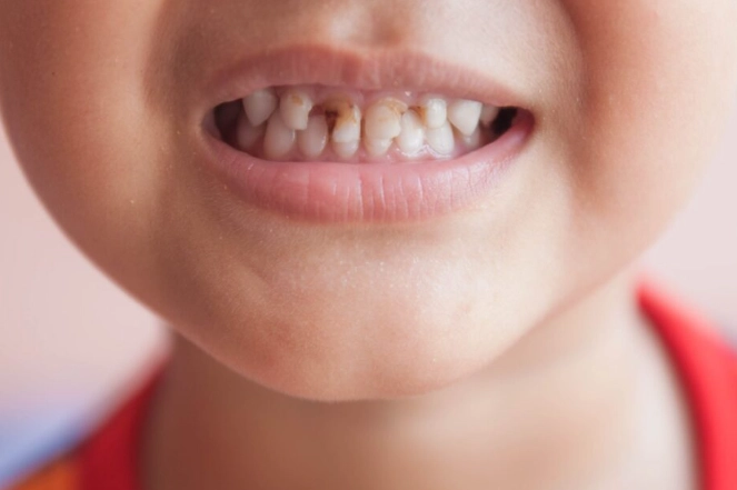 how to prevent cavities from sugar