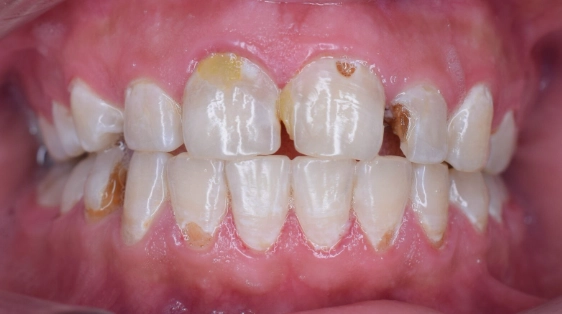 how to prevent cavities from sugar