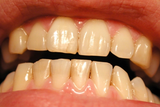 nutrition for healthy gums nutrition for healthy gums